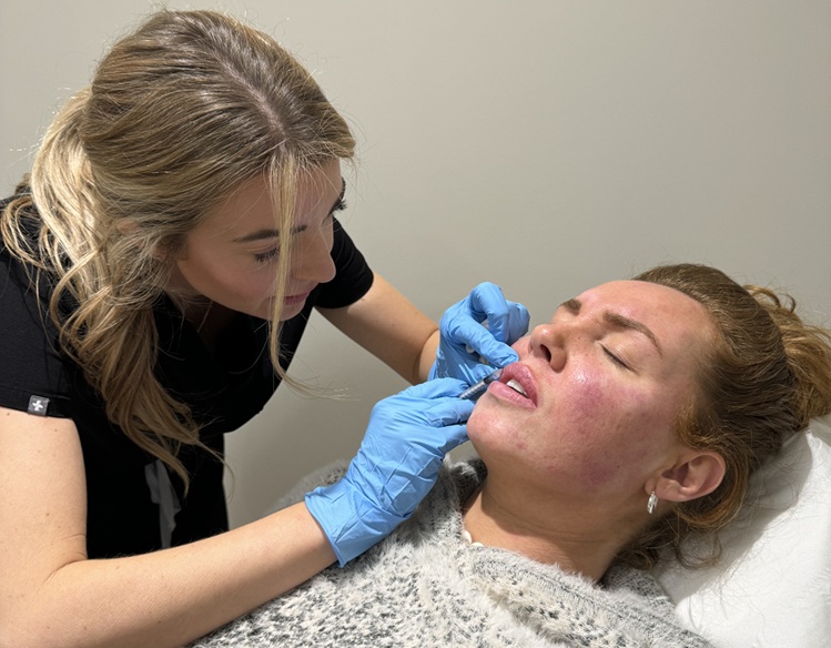 Lip filler in Weybridge 1