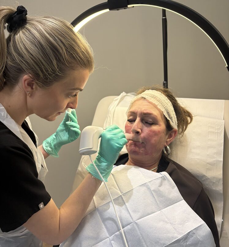 Microneedling Weybridge 1